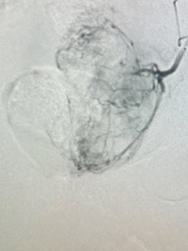 Prostate Artery Embolization