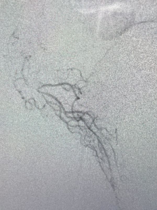 Hemorrhoid Artery Embolization