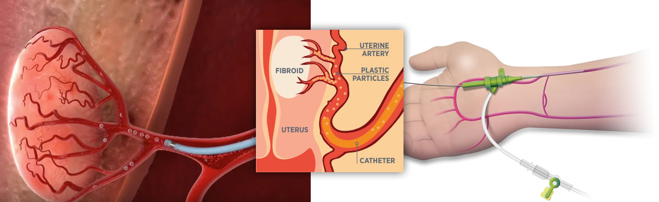 uterine fibroids treatment