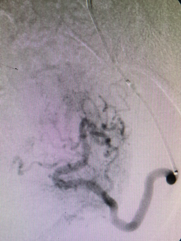 Uterine Fibroid Embolization